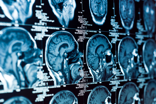  Neuromodulazione, trattamento chirurgico e nuovi farmaci: come migliorare la vita del paziente con epilessia 